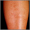 Polyarteritis - microscopic on the shin Polyarteritis - microscopic on the shin