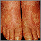 Pityriasis rubra pilaris on the feet Pityriasis rubra pilaris on the feet