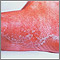 Athlete's foot - tinea pedis Athlete's foot - tinea pedis