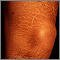 Striae on the leg