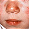 Lupus - discoid on a child's face