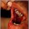 Pemphigus vulgaris - lesions in the mouth Pemphigus vulgaris - lesions in the mouth