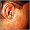 Psoriasis - guttate on the cheek Psoriasis - guttate on the cheek