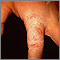 Ringworm - tinea manuum on the finger Ringworm - tinea manuum on the finger
