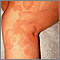 Ringworm - tinea corporis on the leg
