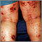 Dermatitis - atopic on the legs