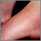Erythema nodosum on the foot Erythema nodosum on the foot
