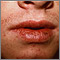 Cheilitis - actinic