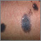 Congenital nevus on the abdomen Congenital nevus on the abdomen