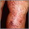 Telangiectasia - legs Telangiectasia - legs