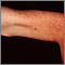Telangiectasias - upper arm Telangiectasias - upper arm