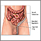 Inguinal hernia repair - series Inguinal hernia repair - series