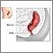 Rectal prolapse repair - series