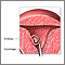 Abortion procedure Abortion procedure