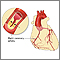 Coronary artery disease