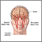 Transient Ischemic attack (TIA) Transient Ischemic attack (TIA)