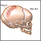 Infant skull fracture Infant skull fracture