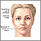 Facial drooping Facial drooping