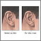 Ear lobe crease Ear lobe crease