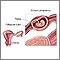 Ectopic pregnancy Ectopic pregnancy