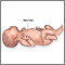 Neonate Neonate