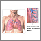 Pulmonary embolus Pulmonary embolus