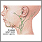 Swollen lymph node Swollen lymph node