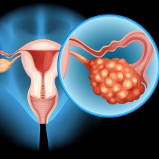 Ovarian Cancer