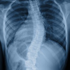 Scoliosis