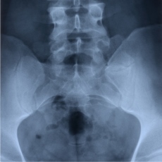 Tailbone Disorders