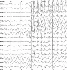 EEG plot of a patient experiencing an epileptic seizure