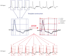 QT interval measurement