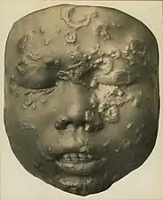 Secondary breakout in a 12-year-old  Javanese child (wax model)