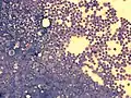 Bone marrow smear from a person with ALL