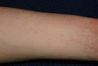 Scabies of the arm