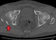 Fracture of the acetabulum