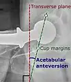 Acetabular anteversion. This parameter is calculated on a lateral radiograph as the angle between the transverse plane and a line going through the (anterior and posterior) margins of the acetabular cup.