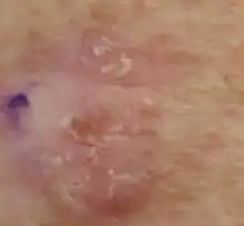 Close up of piece of skin showing pink patches with raised white scales