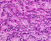 Poor to moderately differentiated adenocarcinoma of the stomach. H&E stain.
