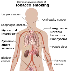 head and torso of a male with internal organs shown and labels referring to the effects of tobacco smoking