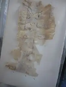 Amoebic intestinal ulcer caused by E. histolytica