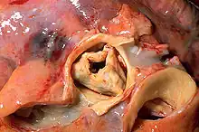 Aorta and coronary arteries at autopsy. The proximal portion of the RCA and its ostium can be seen at the lower left.