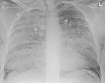 An X-radiograph of the chest of a patient with aspiration pneumonia