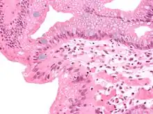 Micrograph of Barrett's esophagus, an example of glandular metaplasia.
