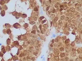 β-catenin immunohistochemistry in solid pseudopapillary tumor, staining the nuclei in 98% of such cases. Cytoplasm is also staining in this case.