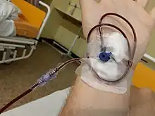Picture of blood transfusion