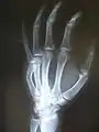 Fracture of the fifth metacarpal (boxer's fracture).