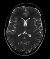 Normal axial T2-weighted MR image of the brain