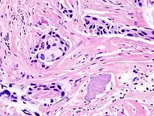 Histopathology of invasive ductal carcinoma of the breast representing a scirrhous growth.