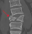 A burst fracture of L4 as seen on CT